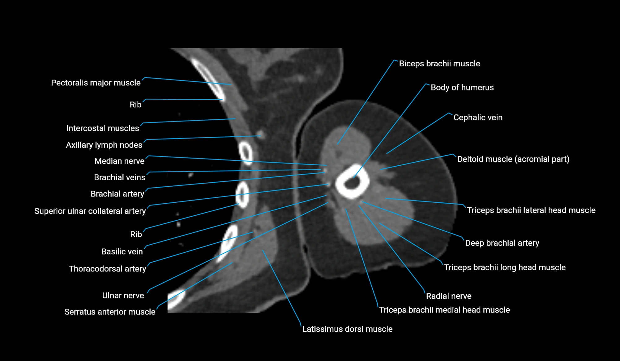 CT upper arm axial  cross sectional anatomy labelled radiology image -00216.webp